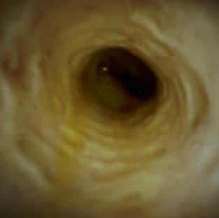 Clinical image of shallow decompressions.