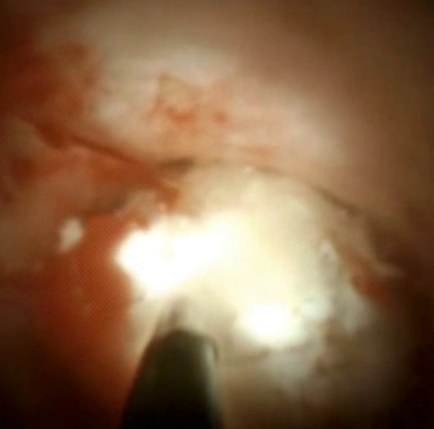 Clinical image of EHL for pancreatic stone.