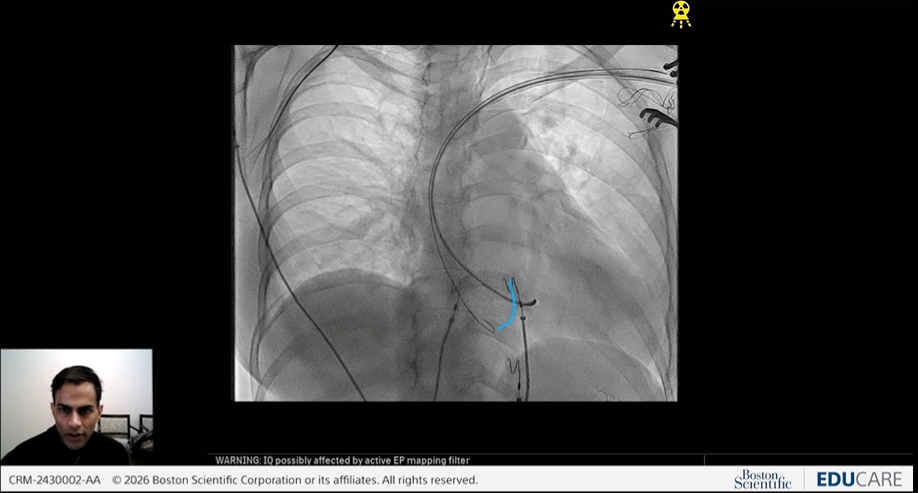 Fluoroscopy view during a live Left Bundle Branch Pacing procedure in the Inside the Procedure webinar.