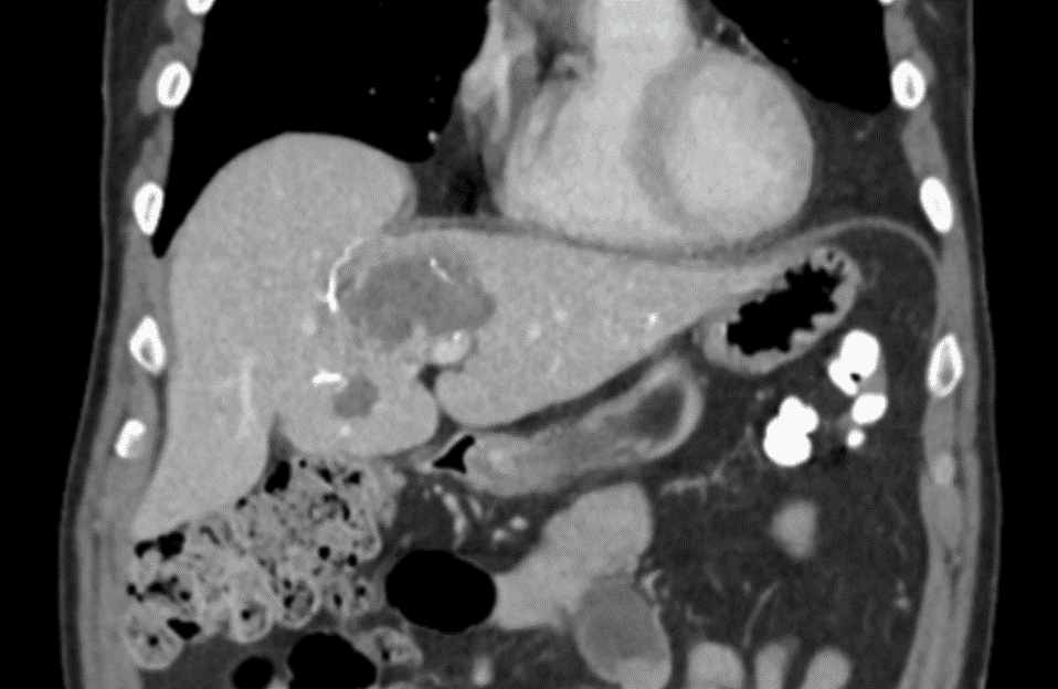 NET: 48th FU; MDCT Coronal Plane