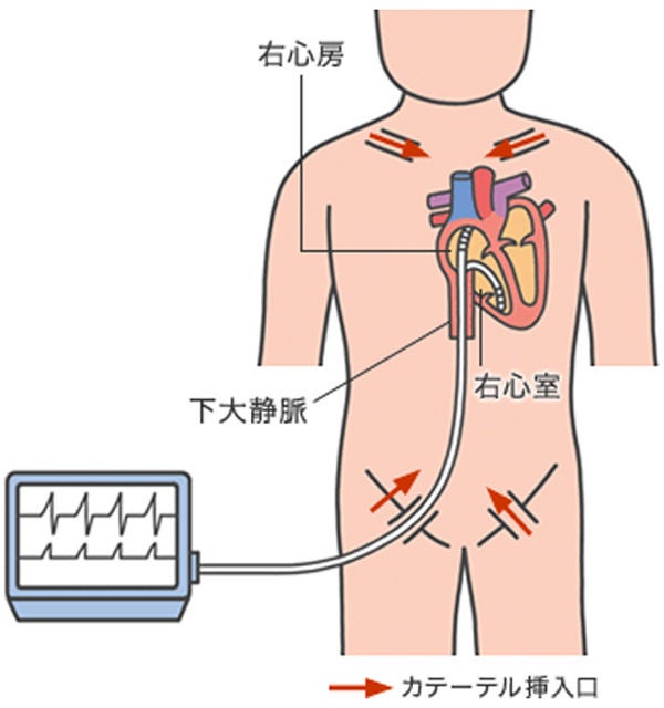 心臓電気生理検査（EPS検査）