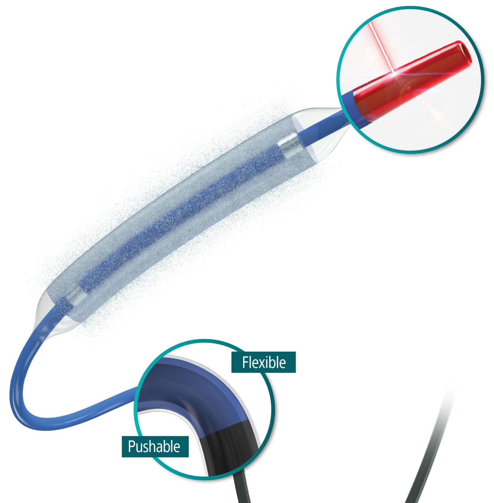 A schematic image of AGENT DCB zooming in on the deliverability benefits of the device.