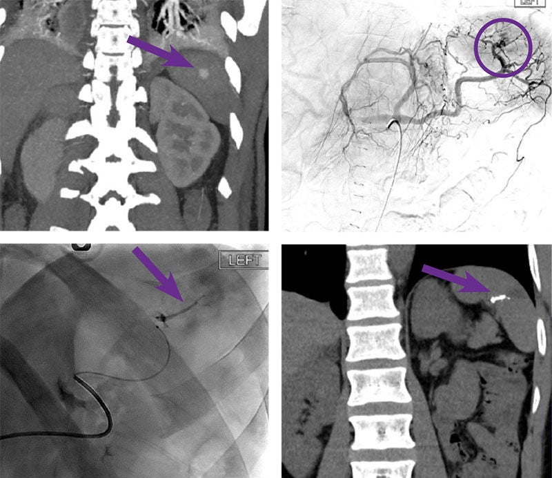 obsidio-splenic-pseudoaneurysm-embolization.jpg