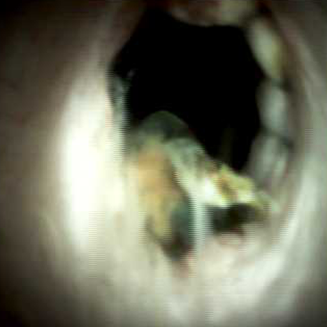 Clinical image of Biliary anastamosis six months (DS I).
