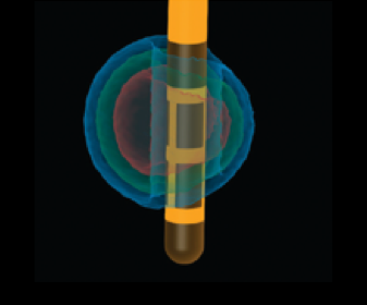 Example image of overlap between initial programming (red), 6-months (green), and 1-year follow-up (blue)