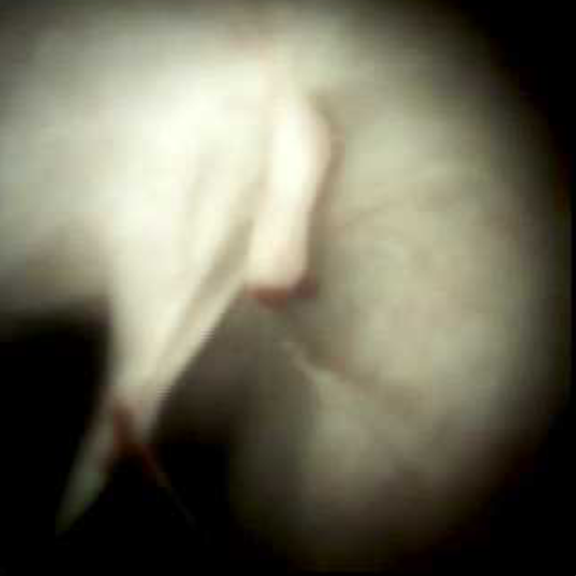 Clinical image of Epithelial bridge (DS I).