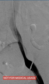 xray image of Iliac vein post-ZelanteDVT.