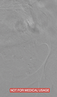 xray of occlusive thrombus extending into the iliac vein.