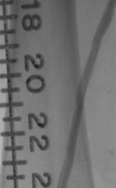 Final angiogram: post-Jetstream atherectomy and adjunctive PTA