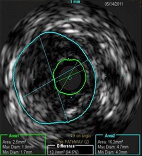 Pre-procedure CTO of right distal SFA/proximal popliteal. Baseline IVUS measurement reveals area of 2.5 mm²
