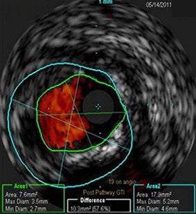 Standalone Jetstream result (prior to PTA) reveals an IVUS measurement of 7.6 mm²