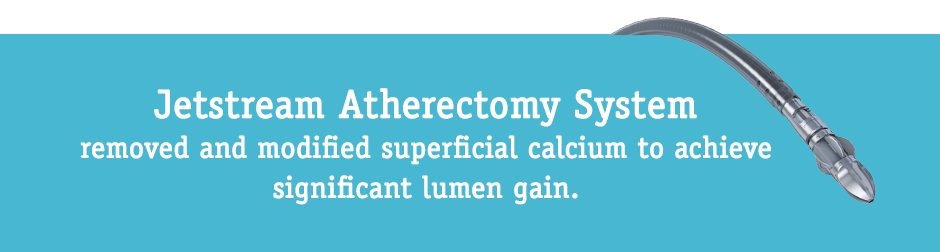 Jetstream Atherectomy System removed and modified superficial calcium to achieve significant lumen gain.