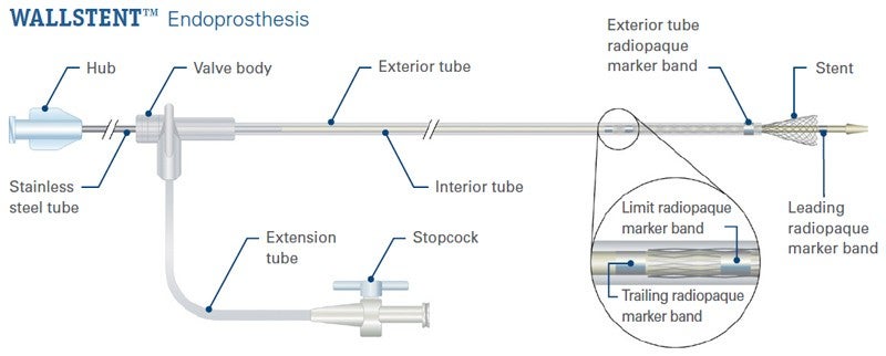 Wallstent Endoprosthesis detailed graphic.