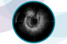 IVUS