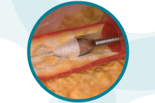 ロータブレーター