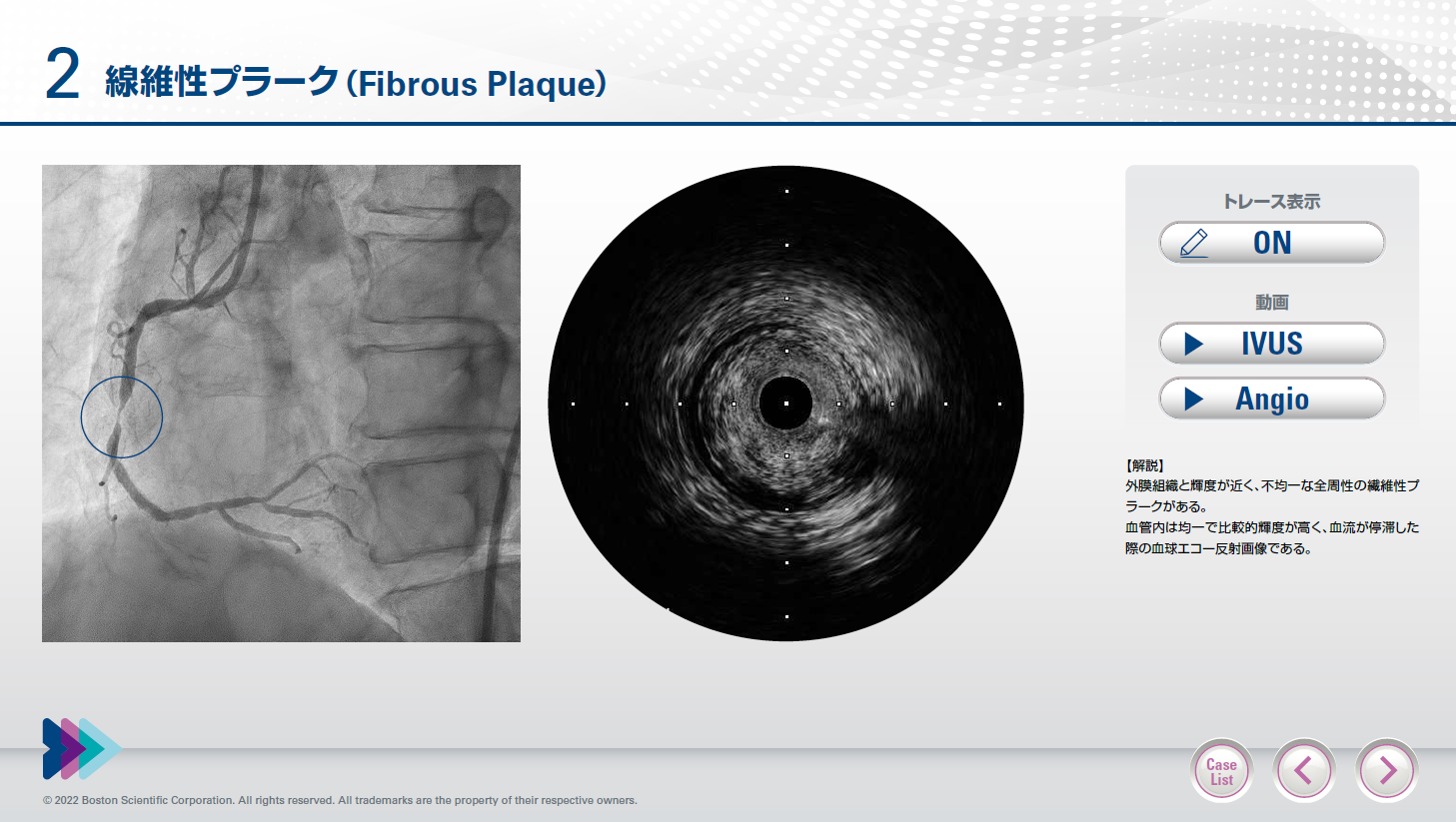 IVUS Imaging Collections