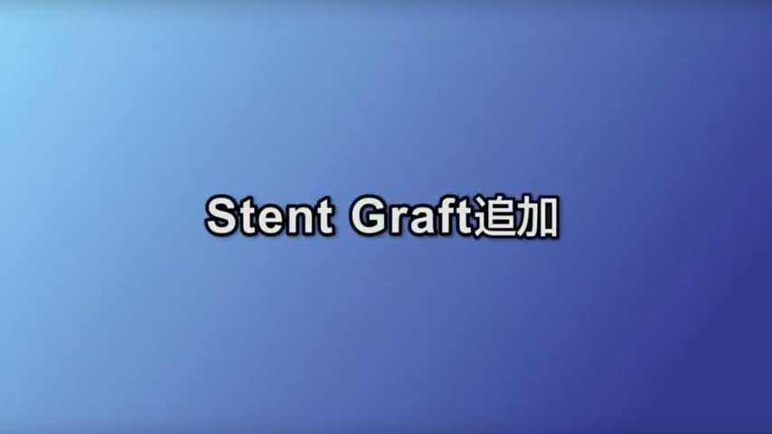 Stent Graft 留置
