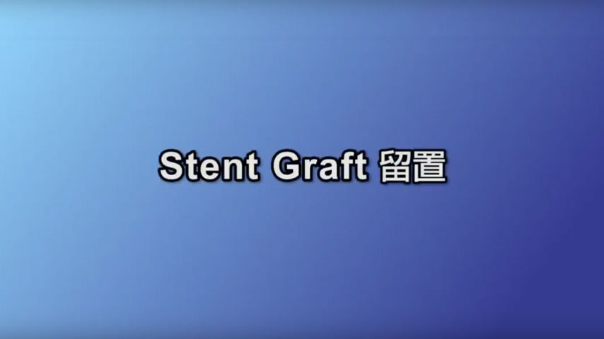 Stent Graft 留置