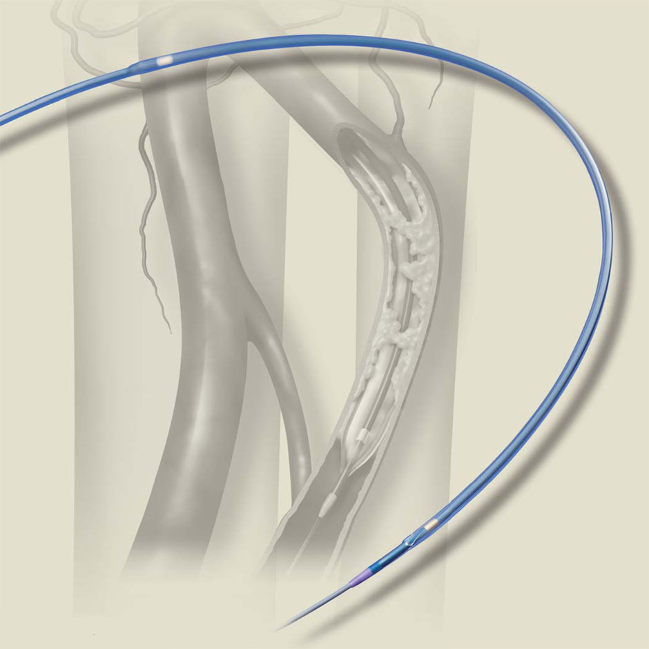 Sterling SL Balloon Dilatation Catheter