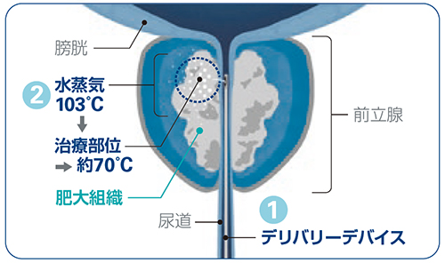 前立腺 肥大 手術 後 の 経過