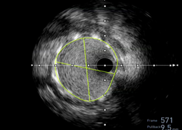 Diagnose with HD IVUS