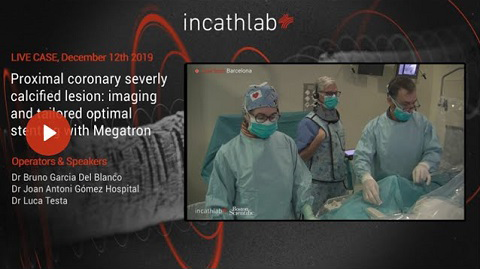 Proximal coronary severely calcified lesion: imaging and tailored optimal stenting with Megatron