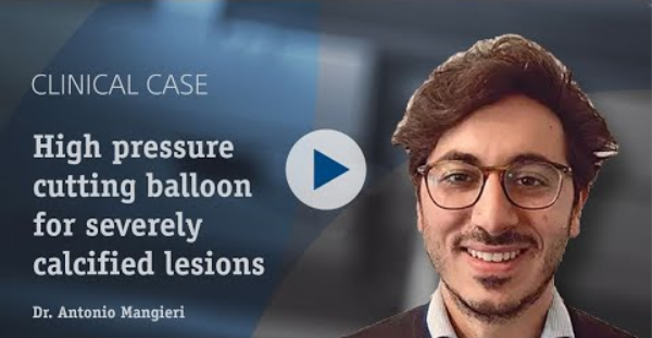 High pressure cutting balloon for severely calcified lesions - Dr. Antonio Mangieri