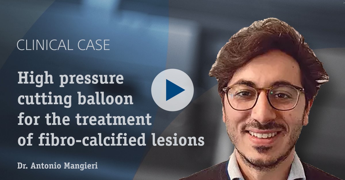 High pressure cutting balloon for the treatment of fibro-calcified lesions Dr. Antonio Mangieri