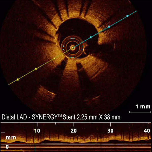 OCT study of LAD stents 2-months post-implant
