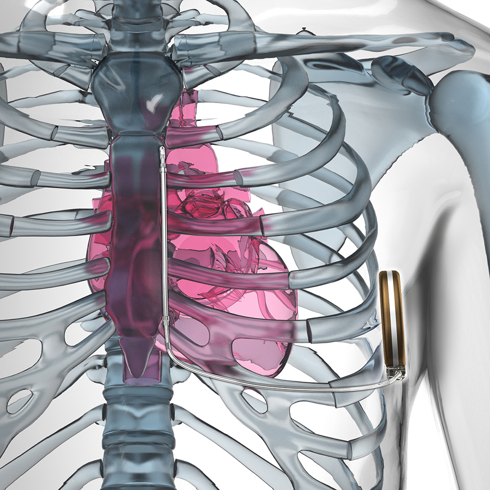 Desfibrilador Implantável Subcutâneo de IRM EMBLEM (CDI-S Sistema)