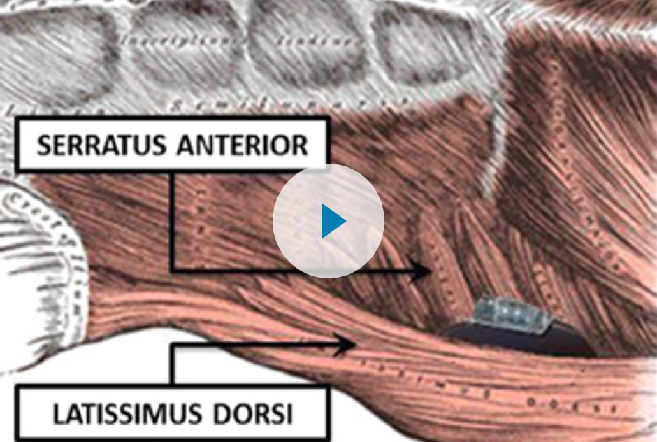 SICD intermuscular image