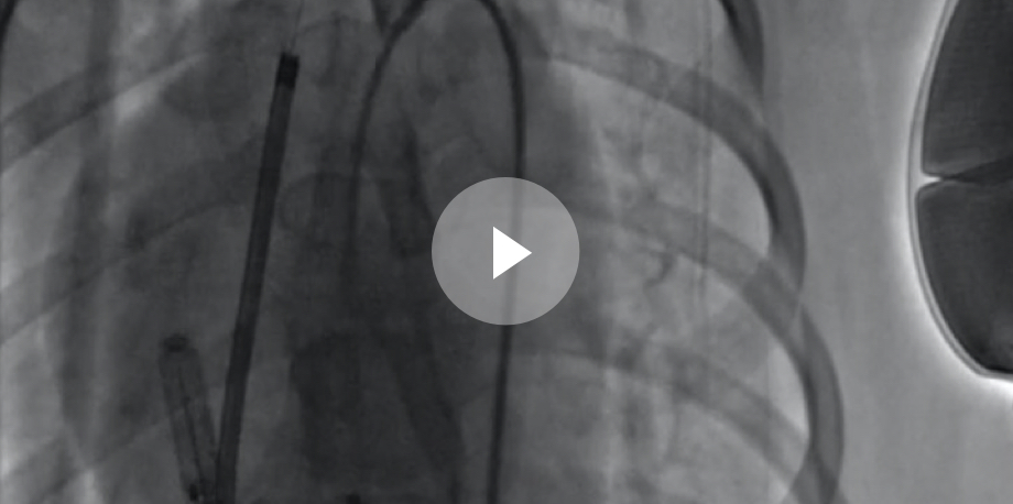 Watch the video to see the coordinated therapy between the EMBLEM S-ICD and EMPOWER Leadless Pacemaker during a mCRM therapy sequence.
