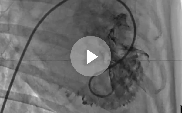 Implant Procedure Fluoroscopy Video