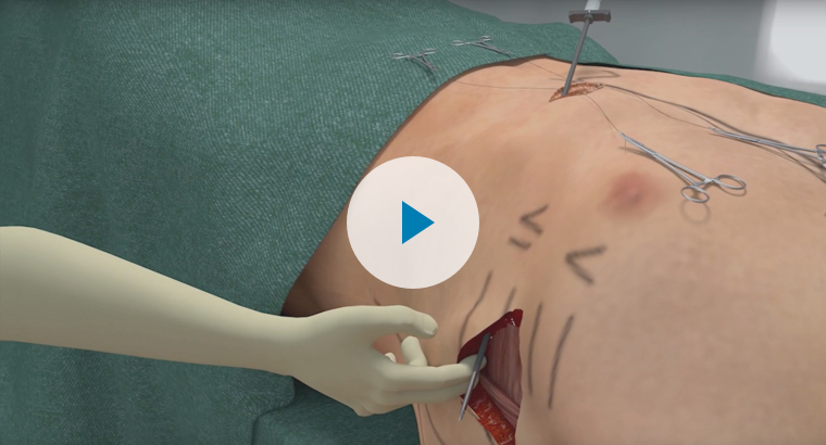 Intramuscular Implant Technique Animation