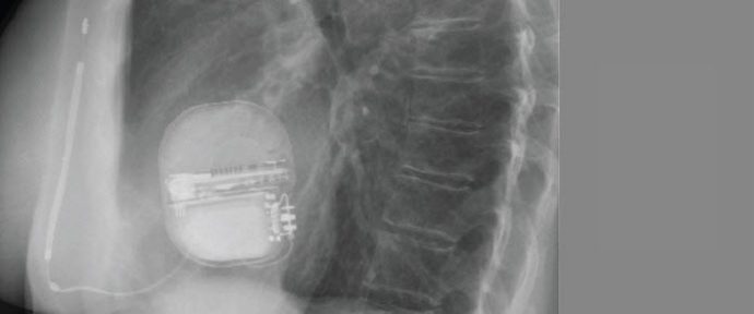 Electrophysiology | Boston Scientific