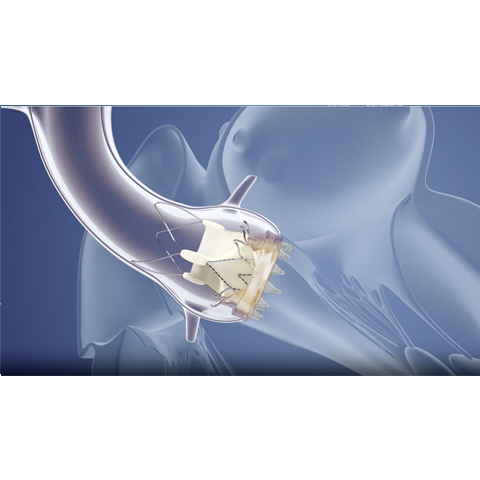ACURATE neo™ Transfemoral Aortic Valve System