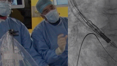 Optimizing Commissural Alignment and Coronary Clearance in TAVI with ACURATE neo2