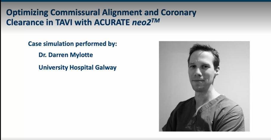 Optimizing Commissural Alignment and Coronary Clearance in TAVI with ACURATE neo2