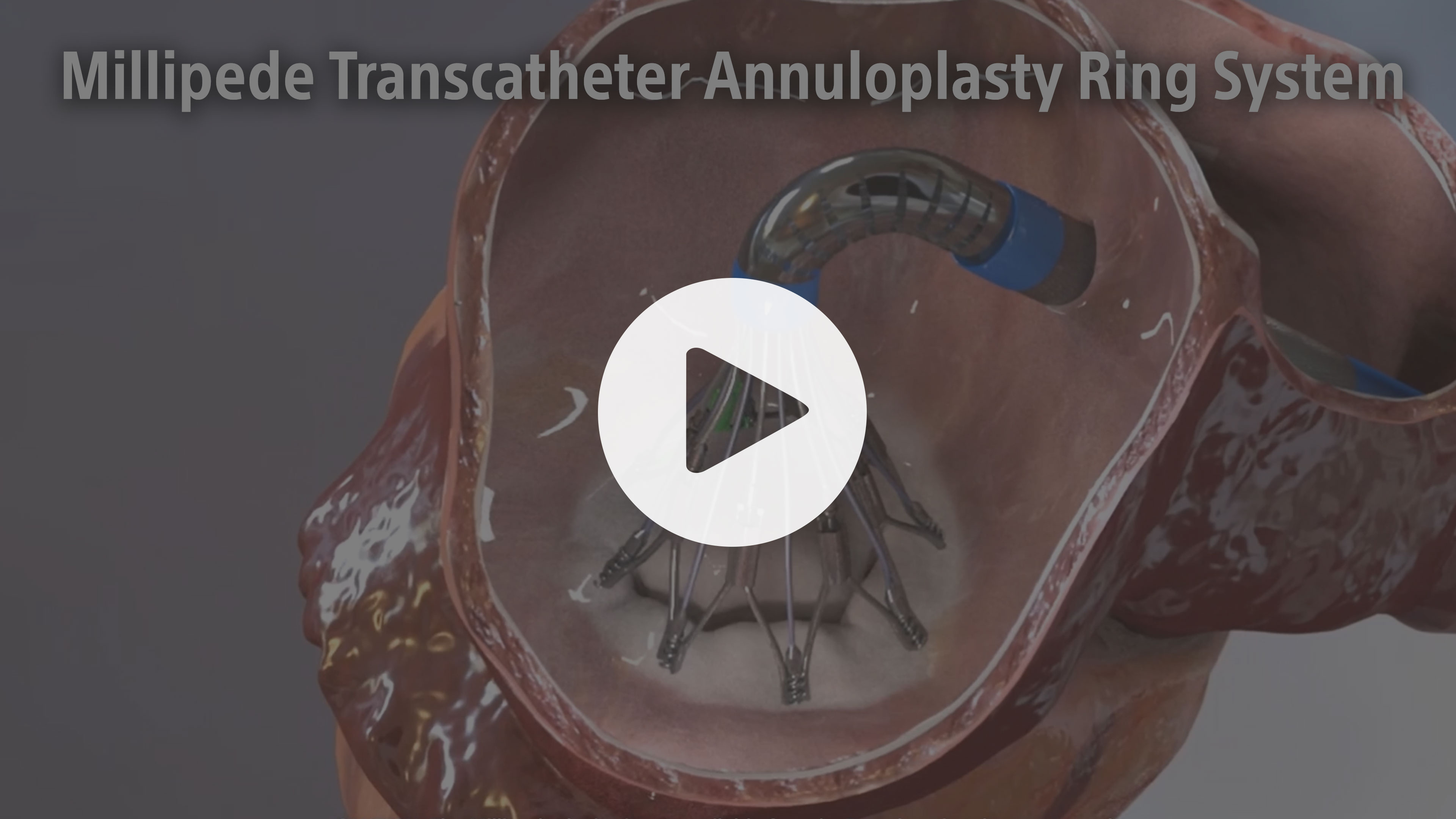 Millipede Transcatheter Annuloplasty Ring - Animation