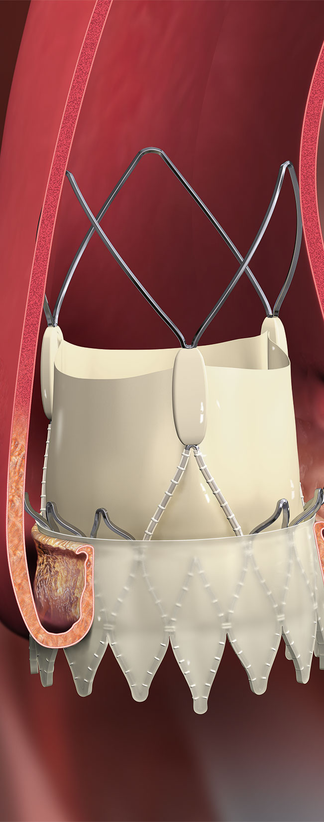ACURATE neo2 Aortic Valve System
