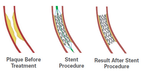 How Coronary Stents Work Patient Information Boston Scientific