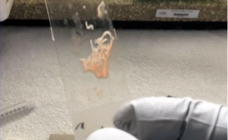 Clinical data on FNA and FNB in tissue acquisition