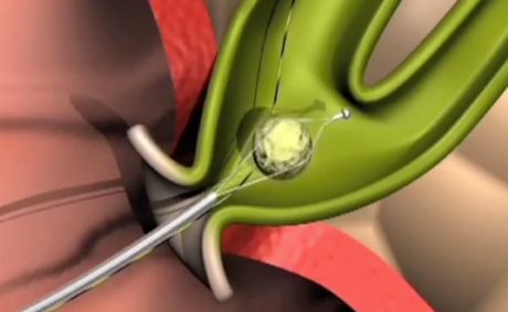 Techniques for Managing Bile Duct Stones