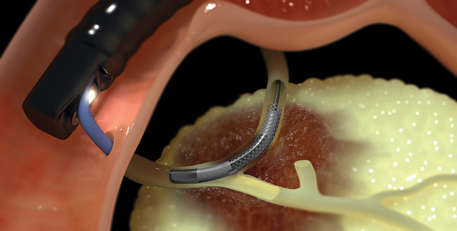 RF ablation catheter restores patency