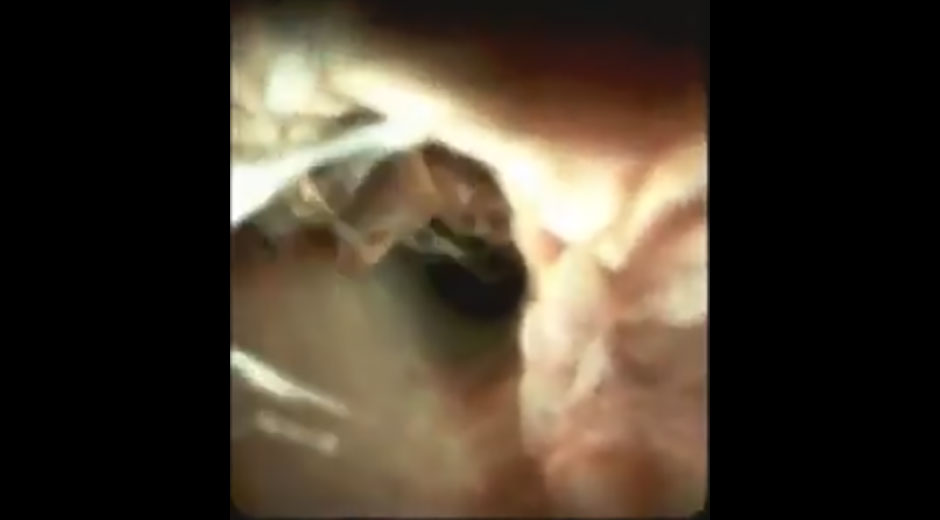 The Role of Cholangioscopy in Main Duct Cholangiocarcinoma