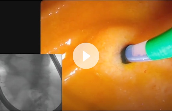 Close-up of EXALT Model D Single-Use Duodenoscope in dorsal pancreatic duct
