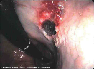 Hiatial Hernia after polypectomy snare before treatment with Resolution® Clip Endoscopy