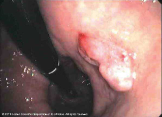 Hiatial Hernia before treatment with Resolution® Clip Endoscopy