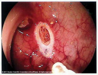 Post Polypectomy site before placement of Resolution® Clip Endoscopic