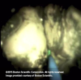 Image of Bile Duct Biopsy Using SpyBite Biopsy Foreceps